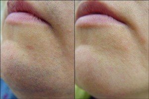 before after IPL laser hair removal on chin