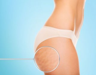 What can we do about cellulite? What can we do about cellulite?