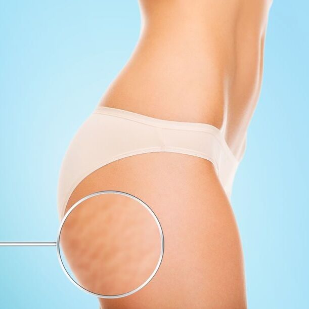 What can we do about cellulite?