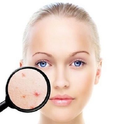 ACNE TREATMENTS IN WANTAGE AT SEGAIS BEAUTY SALON