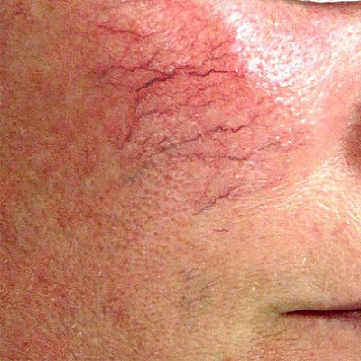 VASCULAR THERAPY AT TOP BEAUTY SALON IN SOUTH OXFORDSHIRE VASCULAR THERAPY AT TOP BEAUTY SALON IN SOUTH OXFORDSHIRE