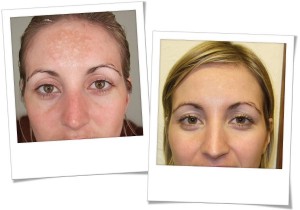 SkinBase Microdermabrasion before & after sun damage